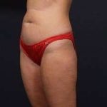 Tummy Tuck Before & After Patient #1284