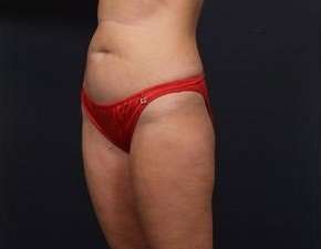 Tummy Tuck Before & After Patient #1284