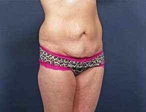 Tummy Tuck Before & After Patient #1289