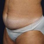 Tummy Tuck Before & After Patient #1296