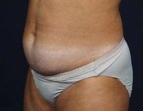 Tummy Tuck Before & After Patient #1296