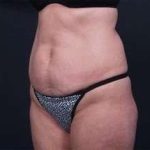 Tummy Tuck Before & After Patient #1303