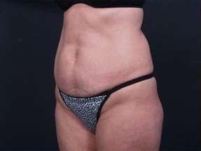Tummy Tuck Before & After Patient #1303