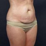 Tummy Tuck Before & After Patient #1310