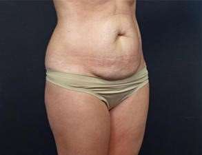 Tummy Tuck Before & After Patient #1310