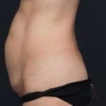 Tummy Tuck Before & After Patient #1315
