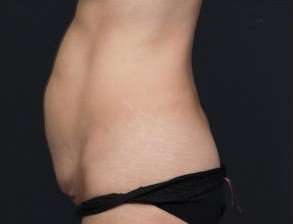 Tummy Tuck Before & After Patient #1315