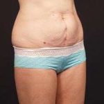 Tummy Tuck Before & After Patient #1322