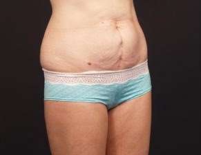 Tummy Tuck Before & After Patient #1322