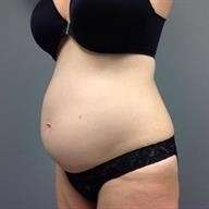 Tummy Tuck Before & After Patient #1327