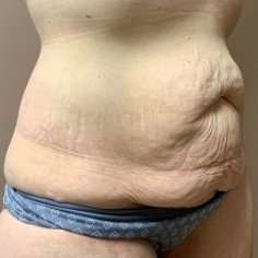 Tummy Tuck Before & After Patient #1332