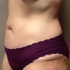 Tummy Tuck Before & After Patient #1337
