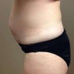 Tummy Tuck Before & After Patient #1349