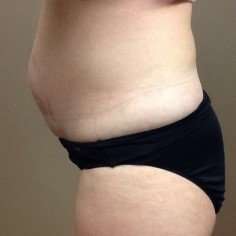 Tummy Tuck Before & After Patient #1349