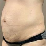 Tummy Tuck Before & After Patient #1354