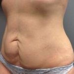 Tummy Tuck Before & After Patient #1359