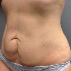 Tummy Tuck Before & After Patient #1359