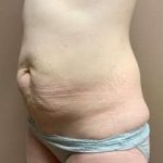 Tummy Tuck Before & After Patient #1364