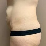Tummy Tuck Before & After Patient #1371
