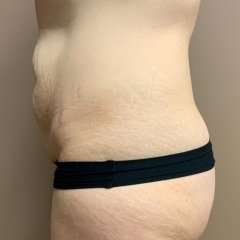 Tummy Tuck Before & After Patient #1371