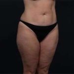 Tummy Tuck Before & After Patient #1378