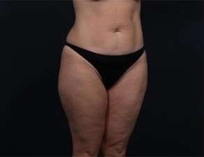 Tummy Tuck Before & After Patient #1378