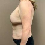 Mommy Makeover Before & After Patient #1383