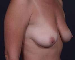 Breast Mastopexy Before & After Patient #209