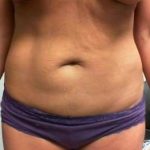 Mommy Makeover Before & After Patient #1395