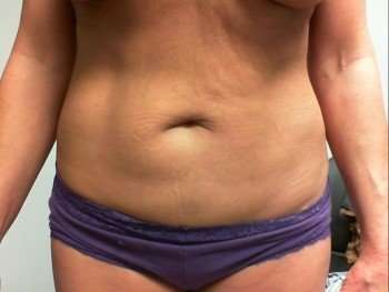Mommy Makeover Before & After Patient #1395