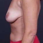 Mommy Makeover Before & After Patient #1405