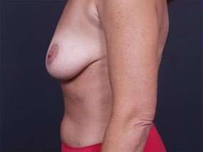 Mommy Makeover Before & After Patient #1405