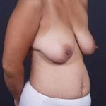 Mommy Makeover Before & After Patient #1423