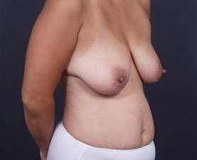 Mommy Makeover Before & After Patient #1423