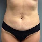 Mommy Makeover Before & After Patient #1445