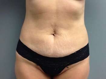 Mommy Makeover Before & After Patient #1445