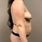 Mommy Makeover Before & After Patient #1477