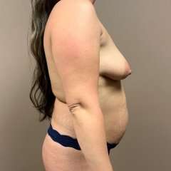 Mommy Makeover Before & After Patient #1477