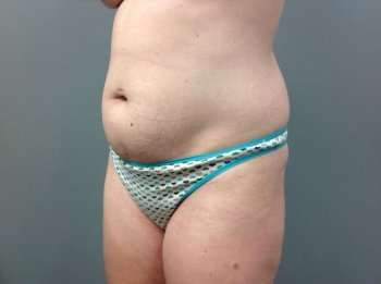 Liposuction Before & After Patient #1485