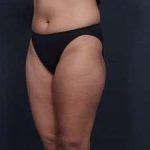 Liposuction Before & After Patient #1492