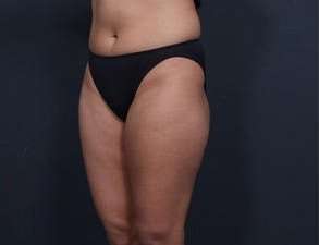 Liposuction Before & After Patient #1492