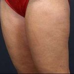 Liposuction Before & After Patient #1499