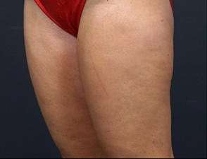 Liposuction Before & After Patient #1499