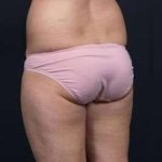 Liposuction Before & After Patient #1506