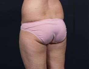 Liposuction Before & After Patient #1506