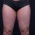 Liposuction Before & After Patient #1513