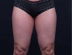 Liposuction Before & After Patient #1513