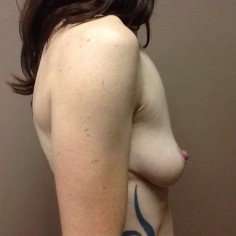 Breast Mastopexy Before & After Patient #252