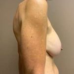 Breast Mastopexy Before & After Patient #266