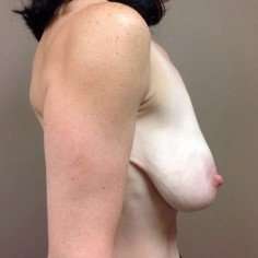 Breast Mastopexy Before & After Patient #271